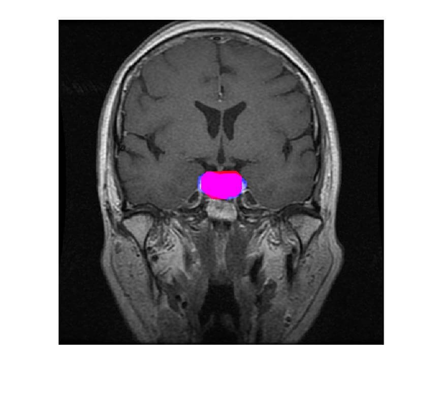 Brain Tumor Segmentation in MRI Images - Image 4