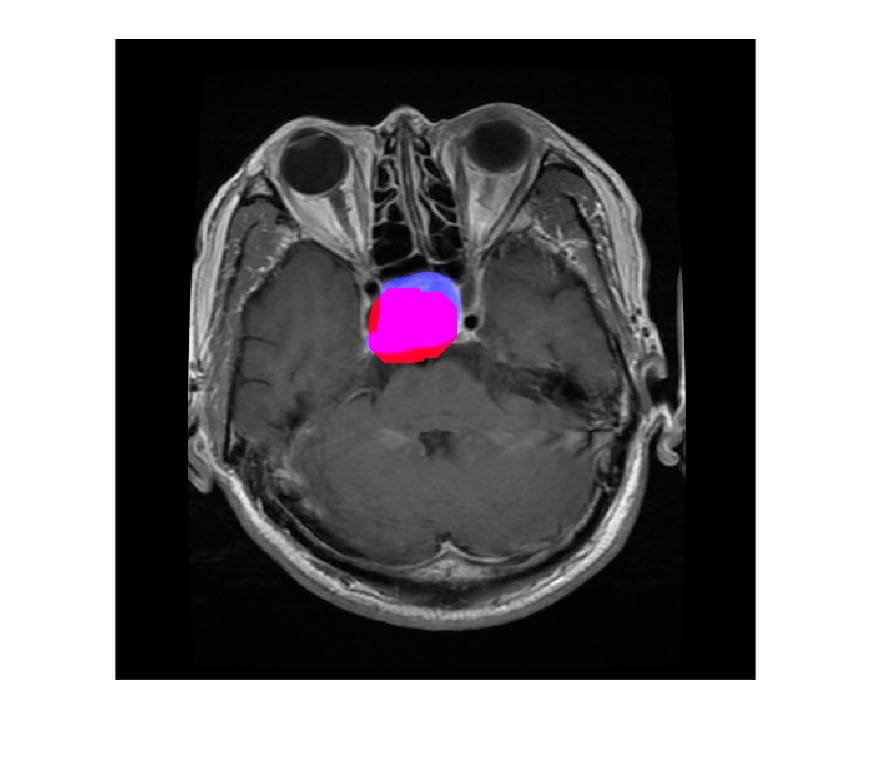 Brain Tumor Segmentation in MRI Images - Image 3